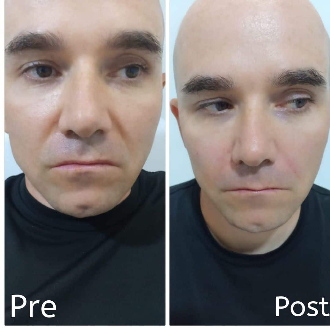 إزالة خط الابتسامة